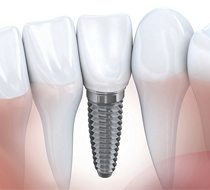 drawing of dental implant