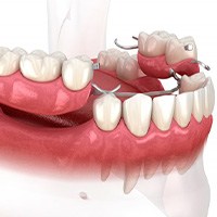 Illustration of partial denture