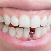 Closeup of smile with dental implant placed