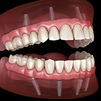 Illustration of implant dentures