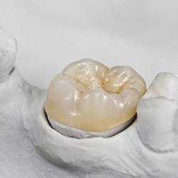 Cust dental crown on model tooth