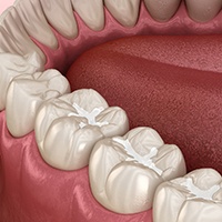 Dental image of tooth-colored fillings 