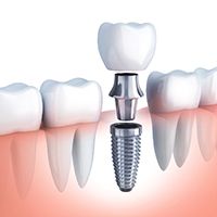 diagram of how dental implants work