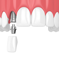 single dental implant being placed in the upper jaw