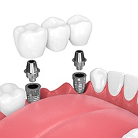 dental bridge supported by two dental implants