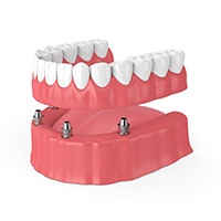 implant denture supported by four implants