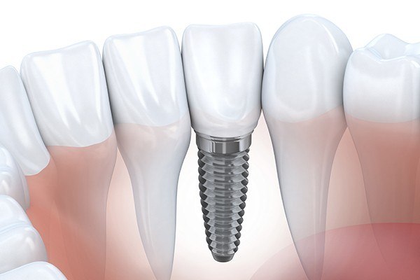 drawing of tooth implant