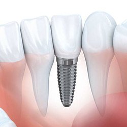 Animation of mini dental implant