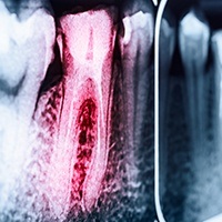 X-ray of root canal treated tooth