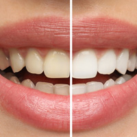 Closeup of a smile that’s half whitened to show before/after results