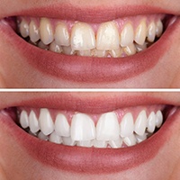 Before and after images of the same smile having been whitened