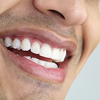Before and after images of the same smile having been whitened