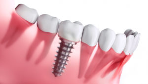 cross-section of dental implant