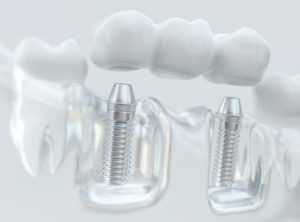 dental implants