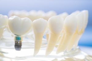 dental implant model