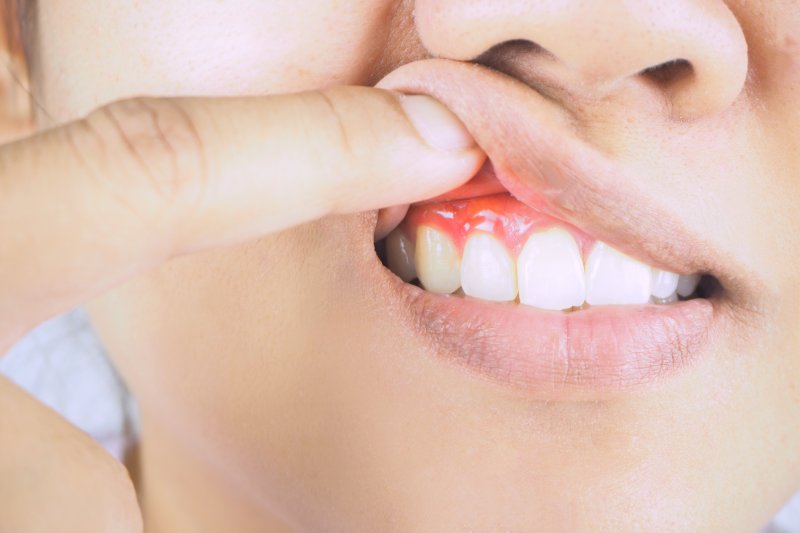 Person pulling up lip to show gum disease