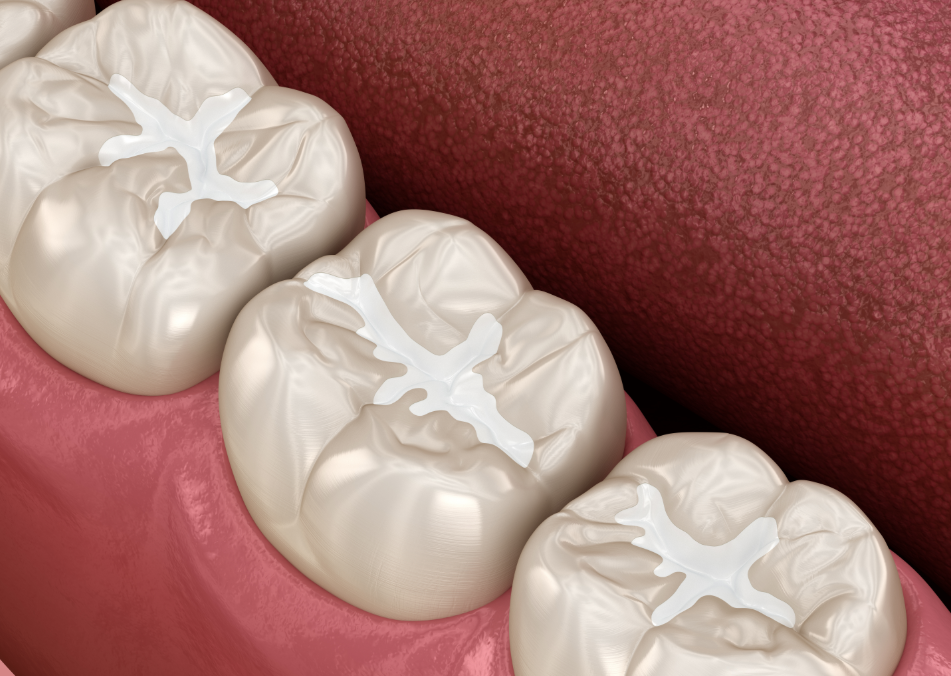 3D image of natural cavity fillings